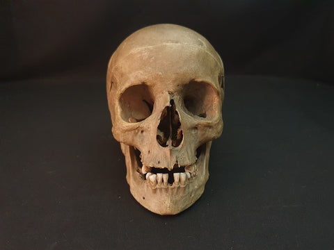 Antique medical real human skull with great colour and patina.