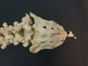  vertebral column / spine and sacrum showing sacralisation