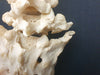  vertebral column / spine and sacrum showing sacralisation