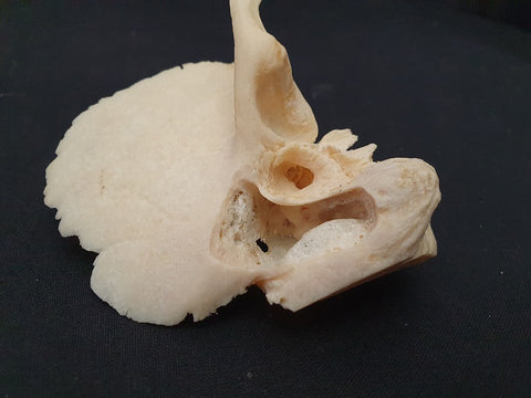 Medically prepared human temporal bone showing surgical dissection