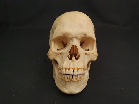 Medically prepared real human skull in case. Excellent condition