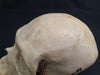 Medically prepared real human skull in case. Excellent condition